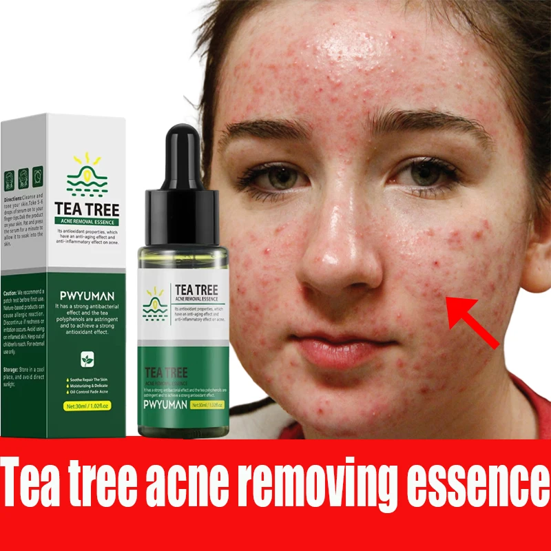 

Tea Tree Acne Removal Serum Repair Pimple Spots Shrinking Pore Remove Blackheads Facial Cleaning Fade Acne Marks Whitening Skin