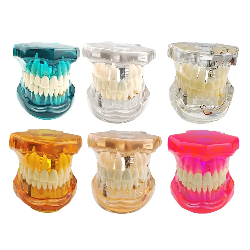 

Dental Study Tooth Model Plant Restoration Model Pathological Teeth Model Fit for Dental Teaching