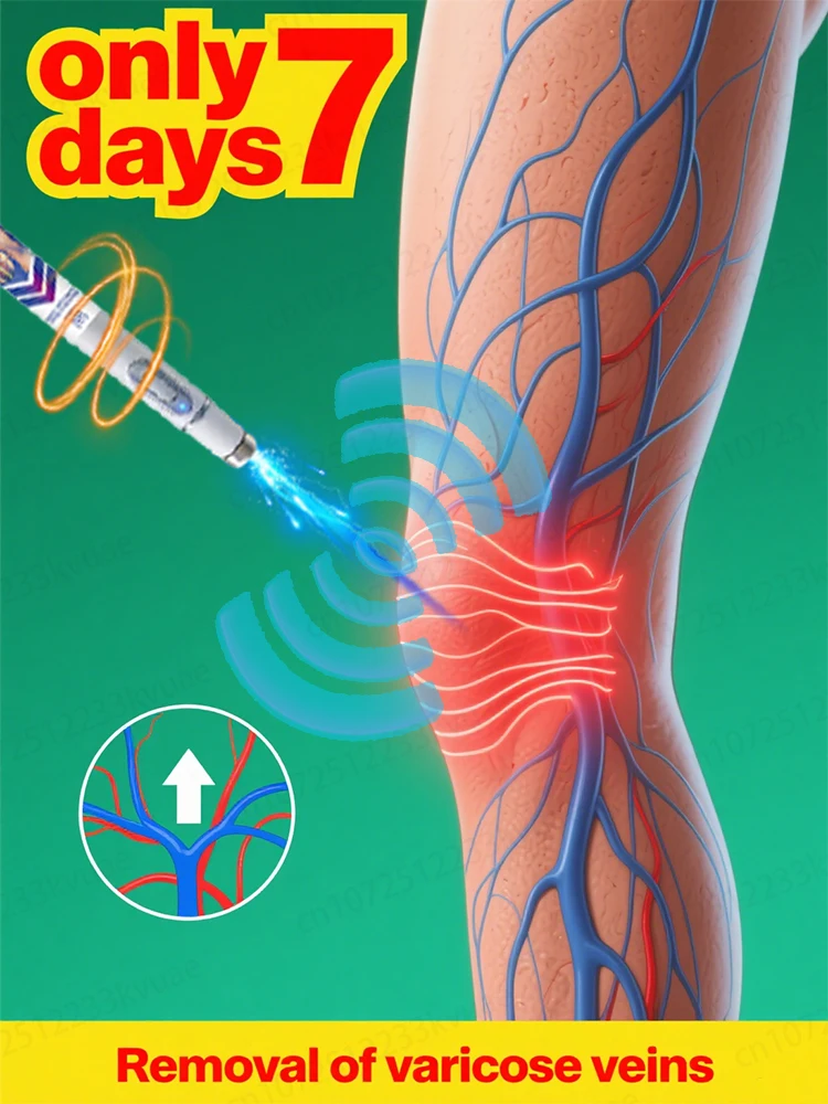 

Generation-2 Laser Says Goodbye To Spider Legs Varicose In 7 Days