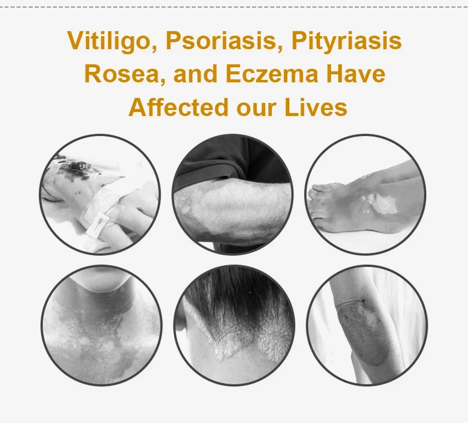 Appareil de photothérapie ultraviolette domestique, lampe remboursable, bande étroite, déterminer le vitiligo et le psoriasis, 311nm