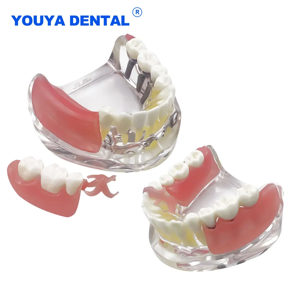 Overdenture With 3 Implant Dental Teaching Model Lower Jaw Removable Bridge Restoration Typodont Interior Mandibular Practice