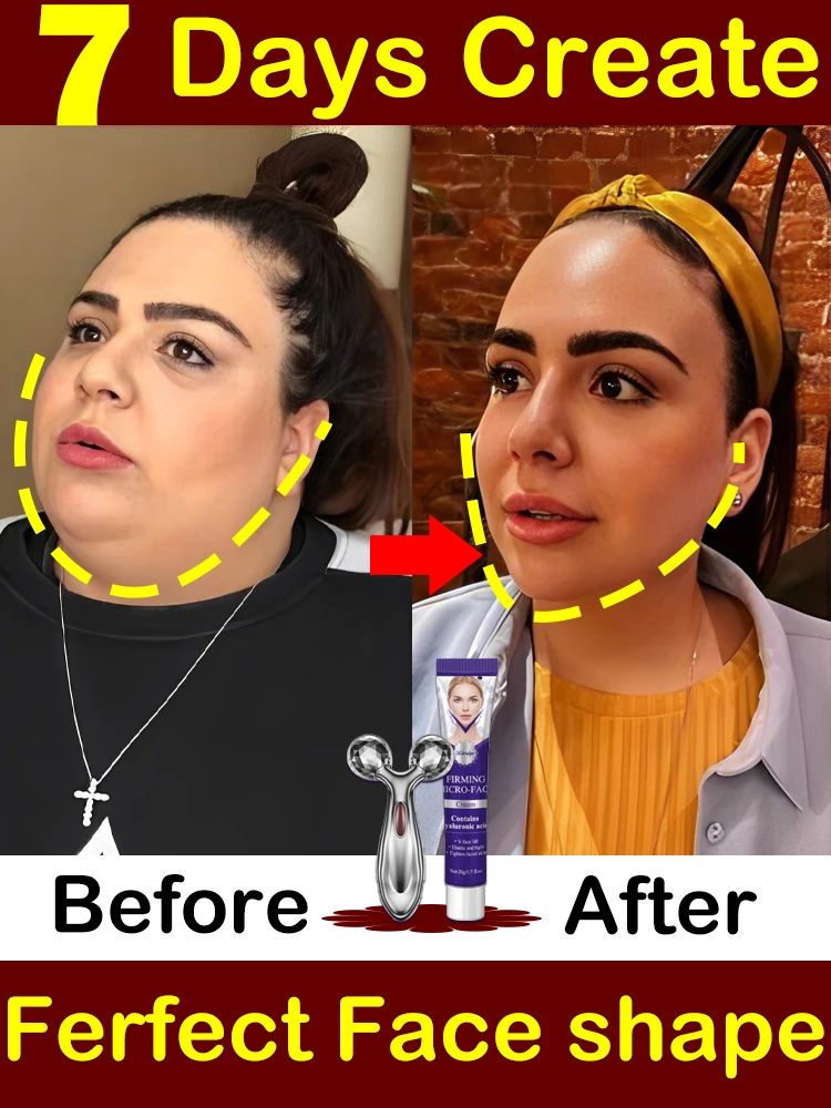 Double chin removal