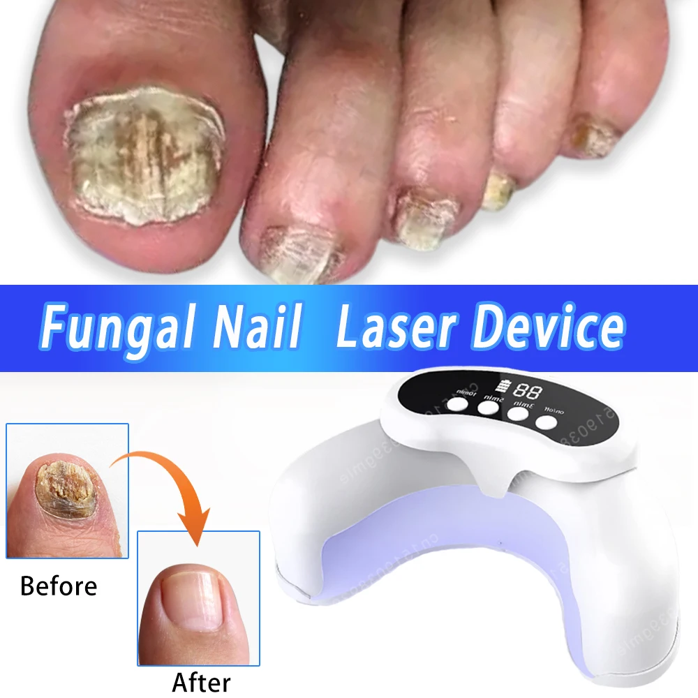 

Nail Fungus Laser Treatment Device Repair Toenail Fingernail Fungus Treat Onychomycosis Laser Nails With Mushrooms Remove