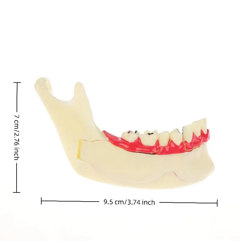 Modelo anatômico de tratamento endodôntico dental, tecido mandíbula de goma para dentista, ensino, estudo, modelo de dentes de demonstração