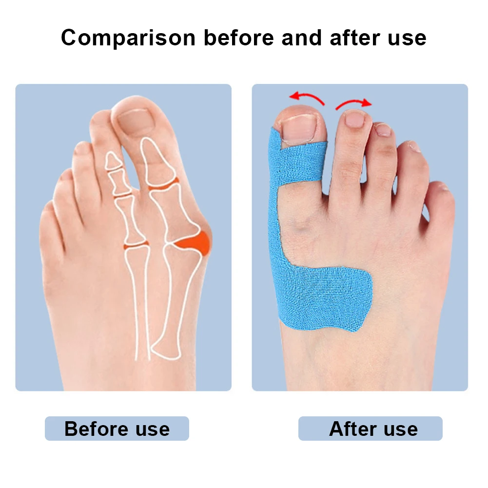 Corrector de juanete, alisador de juanete, separador de dedos transpirable, Corrector de órtesis de Hallux Valgus autoadhesivo para hombres y mujeres, 10 Uds.