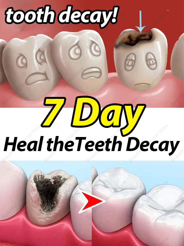 

Solve caries and teeth decay problem