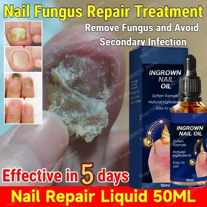 ขายร้อน Fungal NAIL Removal 10ML Fungal NAIL Foot Repair Essence เล็บเชื้อราเจลกําจัด Anti Infection