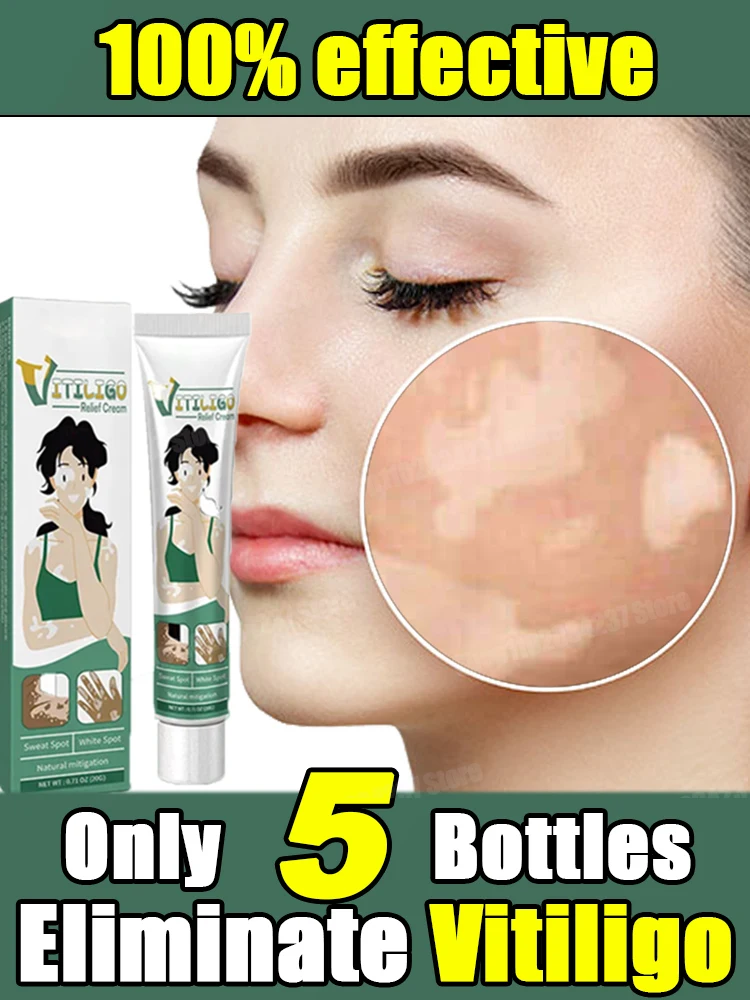 White Spot Cream for Vitiligo White Spots Leukoplakia Pigmentation Melanin Promoting Vitiligo Cream Skin Care 1