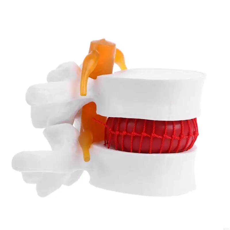 W89C الإنسان تشريحي القطني الفتق الفتق النموذج الطبي تعلم المعونة تشريح المعونة