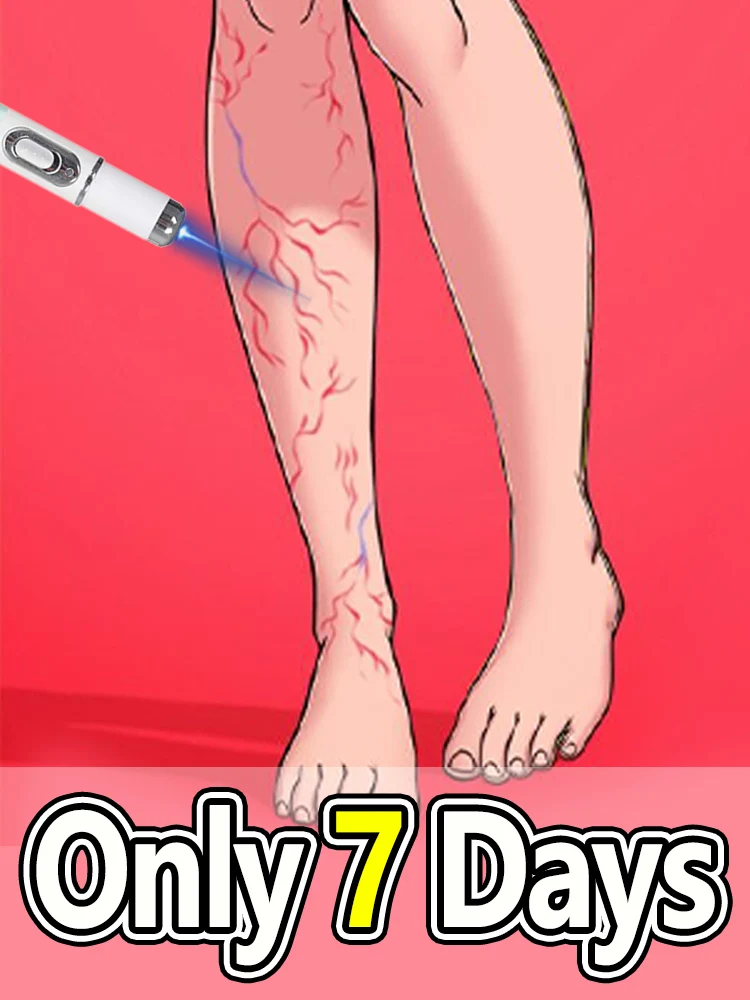 

Generation-2 Laser Says Goodbye To Spider Legs Varicose In 7 Days Mini varicose vein blue light device: Painless leg care