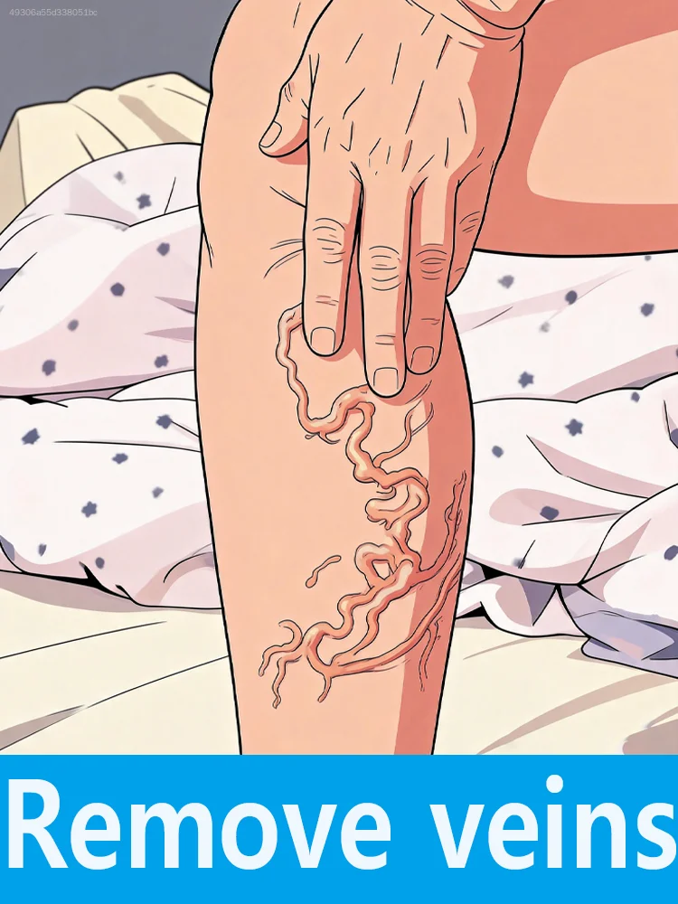 Gᴇᴛ ʀɪᴅ ᴏғ sᴡᴇʟʟɪɴɢ ᴀɴᴅ ᴘᴀɪɴ,soothe your legs and say goodbye to discomfort—a reliable choice.