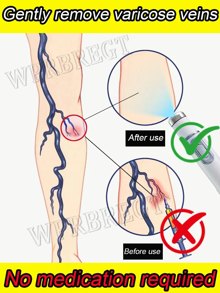 

Solve a problem: Laser treatment of varicose veins and phlebitis to promote blood circulation