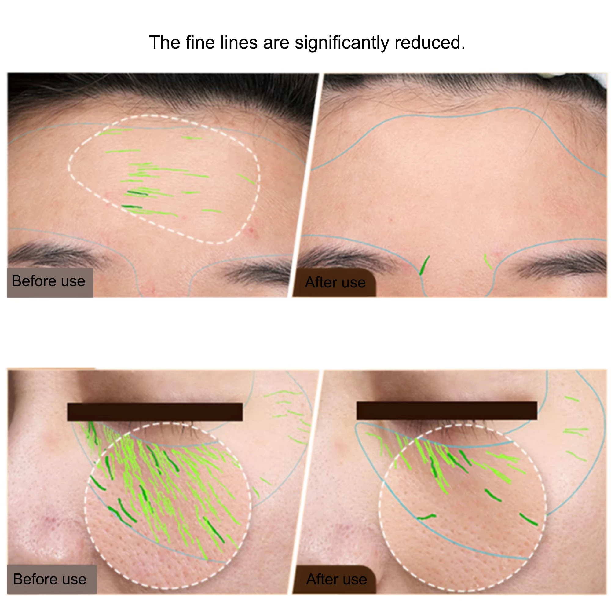 Ems corpo facial máquina de radiofrequência aperto da pele face lifting rf dispositivo beleza profissional casa rf cuidados com a pele anti envelhecimento