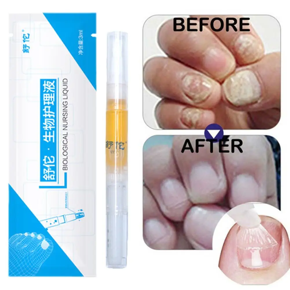 Laser Pointer Pen Nail Painless Nail Repair Pen With Nail Fungus Remove Fungus Nail Lazer Pointer Pen