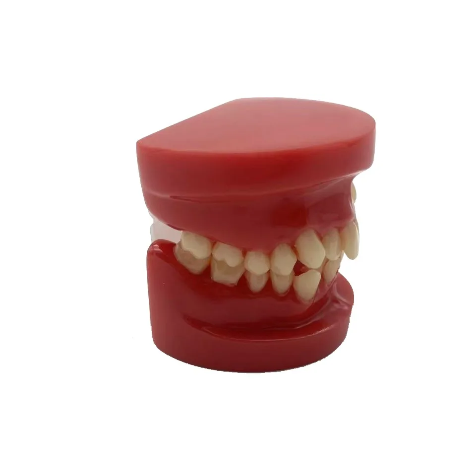 Dental Orthodontic Model Red Malocclusion Teeth Crowding Crossbite Dental Model Practice Bonding Brackets