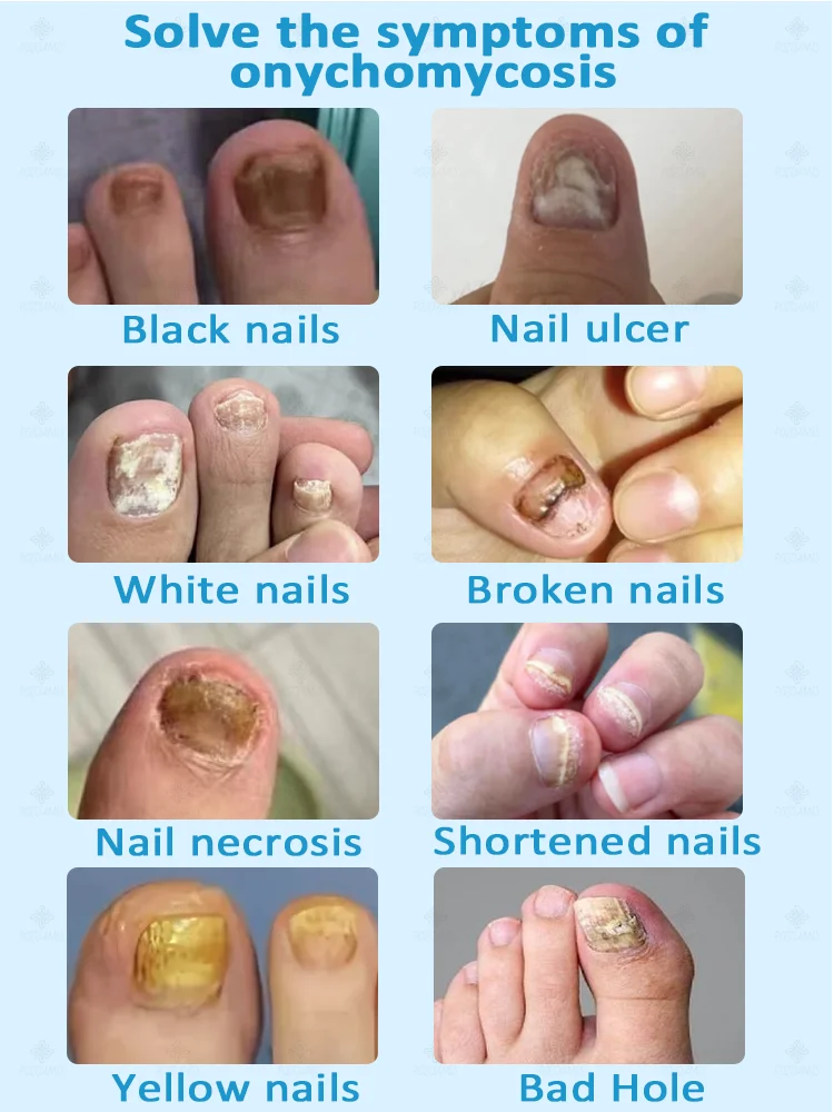 7일 만에 완고한 곰팡이 제거