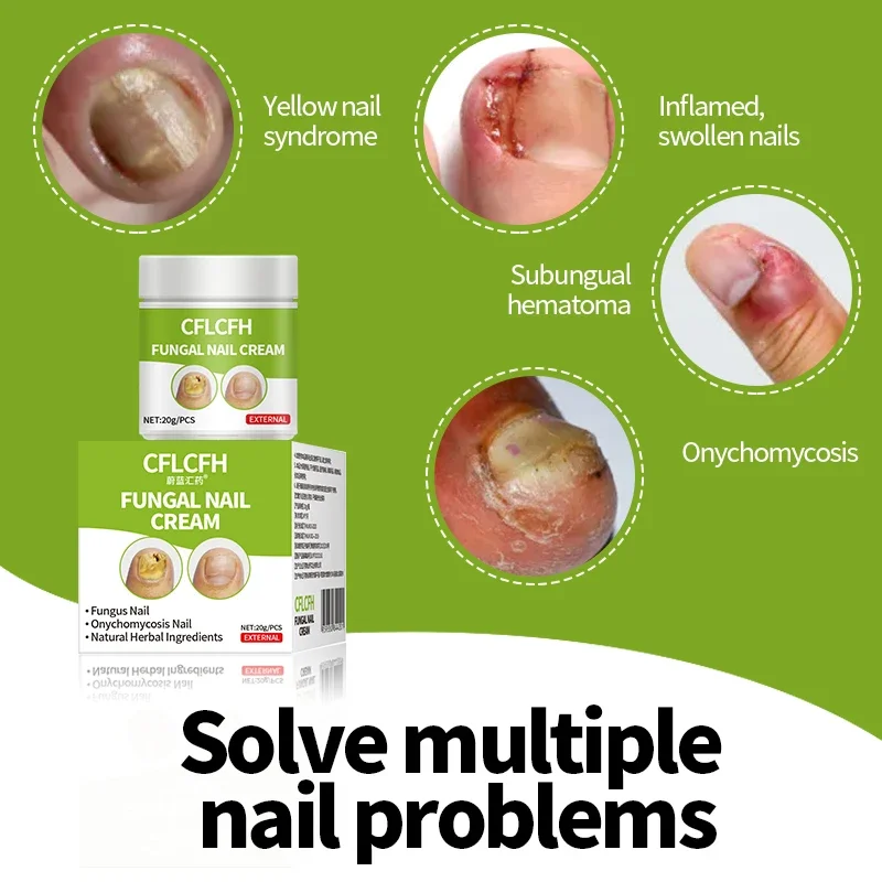 Nail Fungus Treatment Cream Anti Infection Fungal Nail Repair Onychomycosis Removal Paronychia Ingrown Toenail Care Plaster