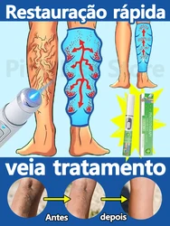 Vena de pierna Nano láser, gran oferta