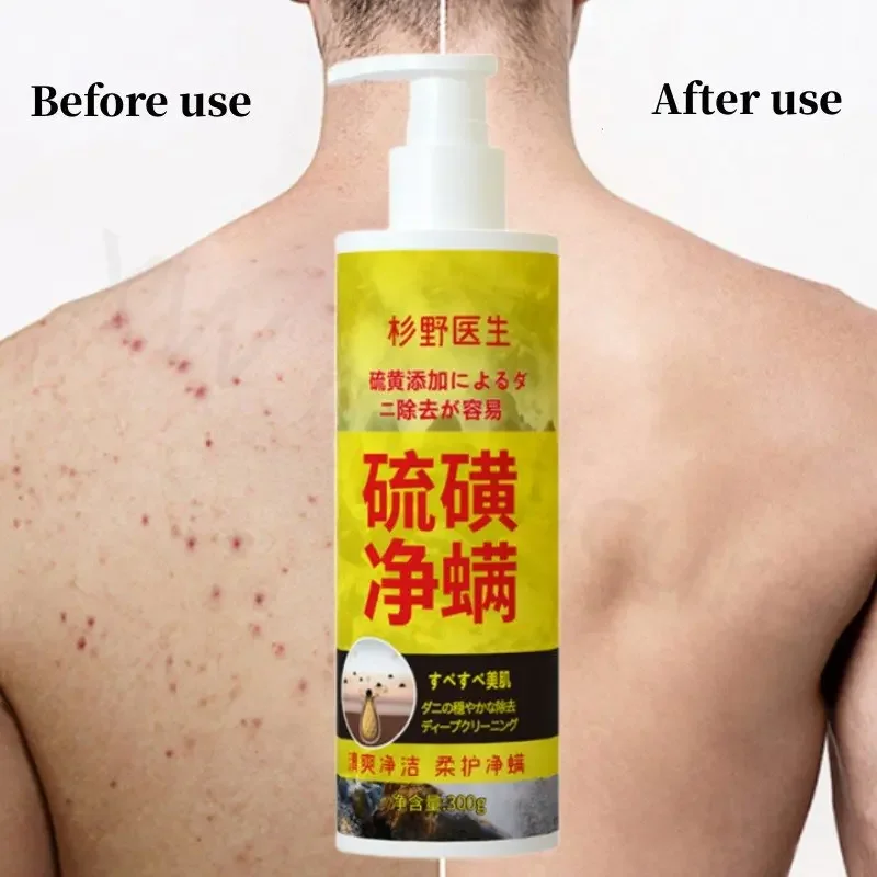 

Exfoliating Relieve Back Erythema Deep Cleansing Anti-acne Itching Hydrating Men and Women Remove Mites Sulfur Mite Shower Gel