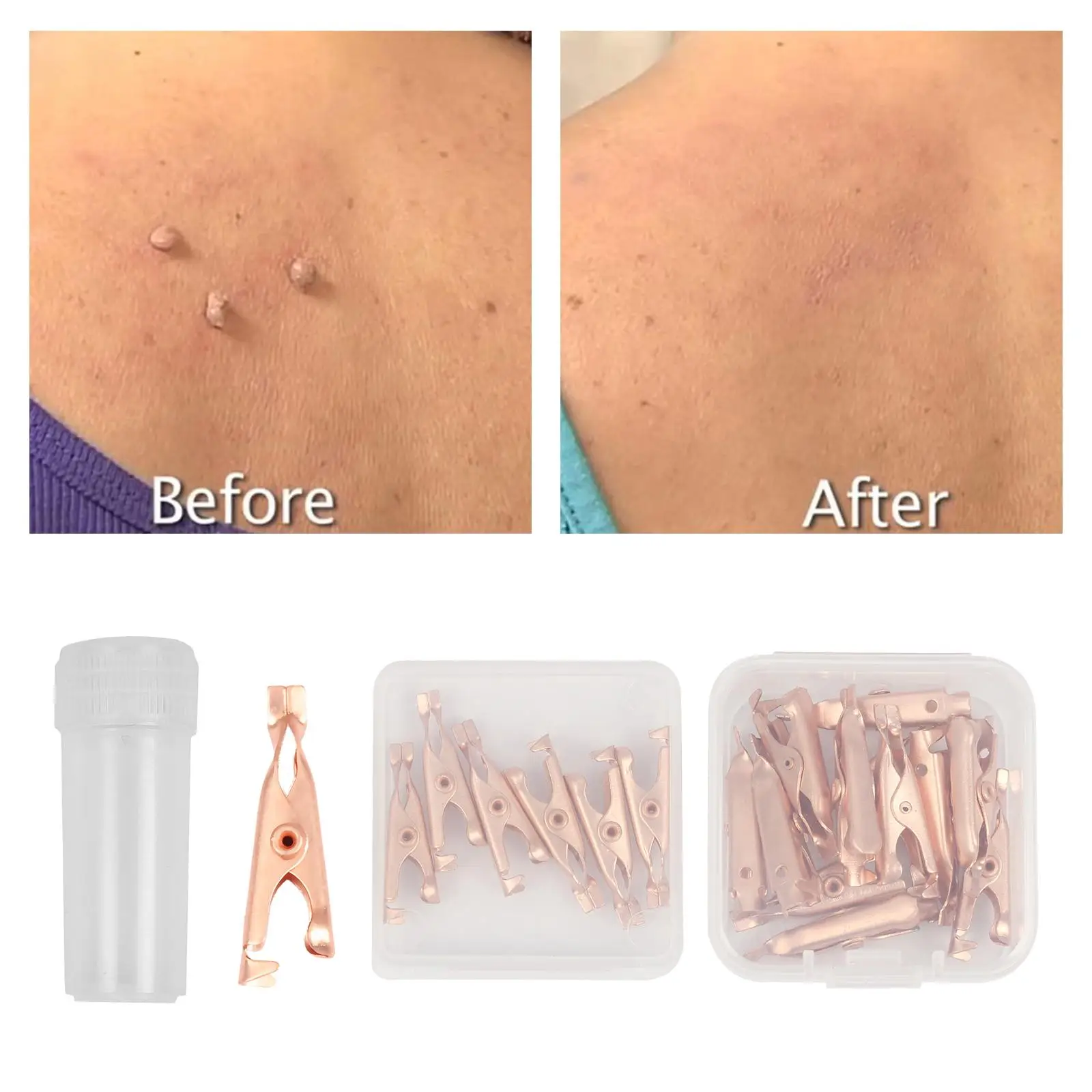 مشابك إزالة علامات الجلد الصغيرة، علامة نحاسية، مستخرج علامات الثآليل للجنسين #3