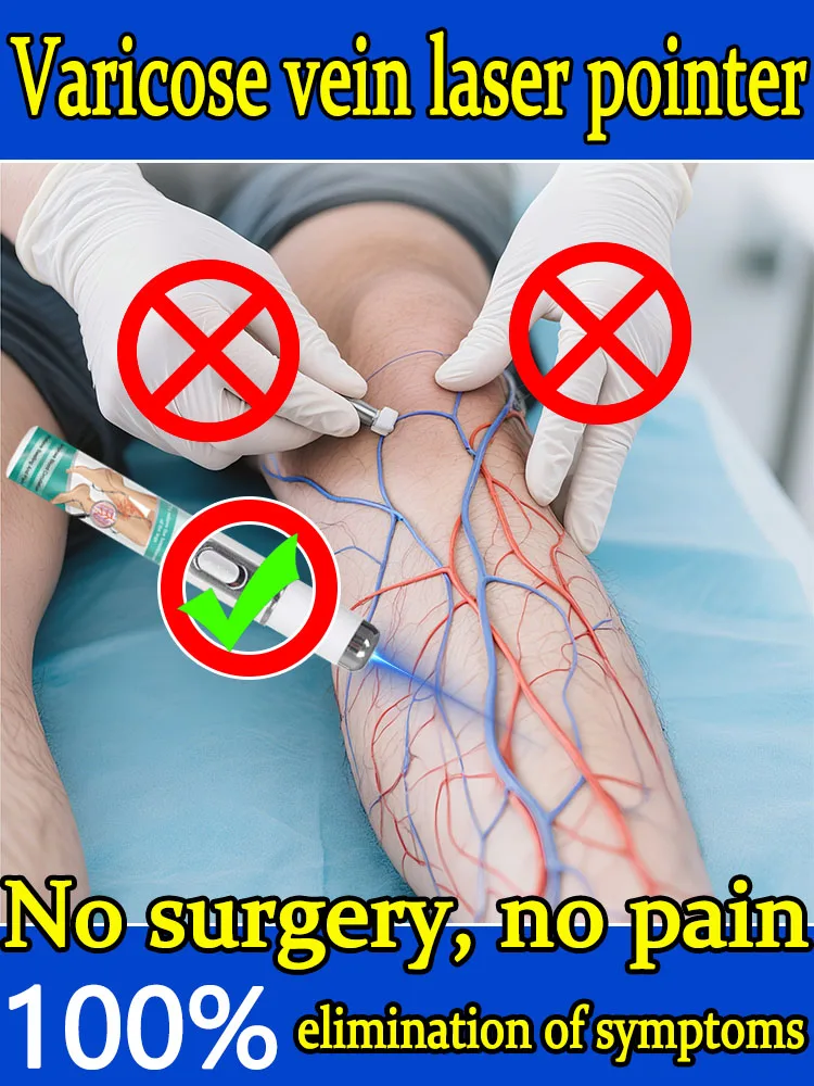 

varicose vein laser eliminates vasculitis and phlebitis, relieves spider leg pain, laser pointer for treatment