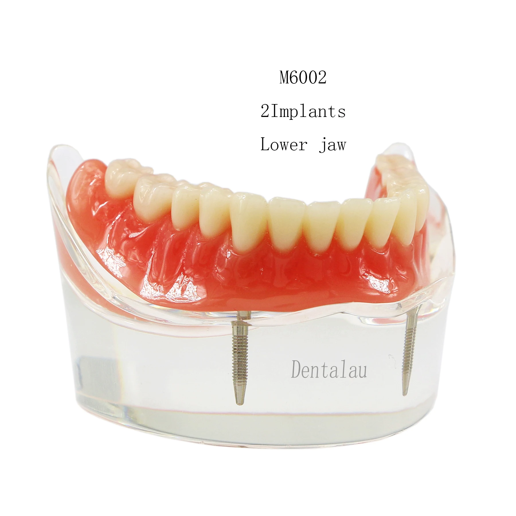 M6002 Dental Research  Overdenture Models Dental Implant Typodont Teeth Demo For Teach Study