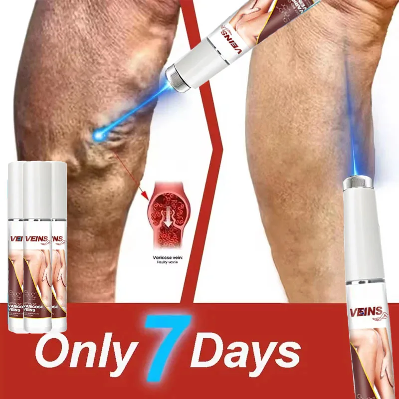 

Generation Varicose Vein 3nd Laser Pointer Treatment Laser Eliminates Vasculitis and Phlebitis Relieves Spider Leg Pain Tool