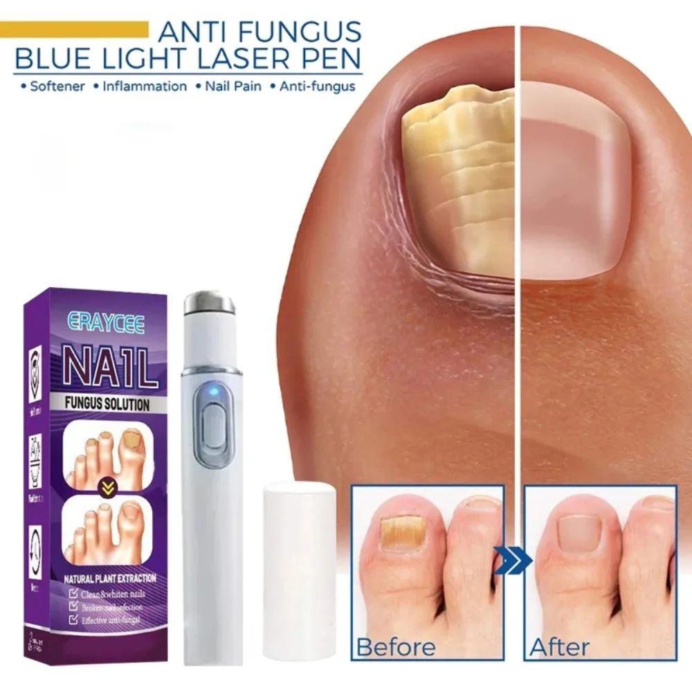

Портативная медицинская лазерная ручка для грибка ногтей, устройство для восстановления ногтей на ногах для ремонта грибковых инфекций
