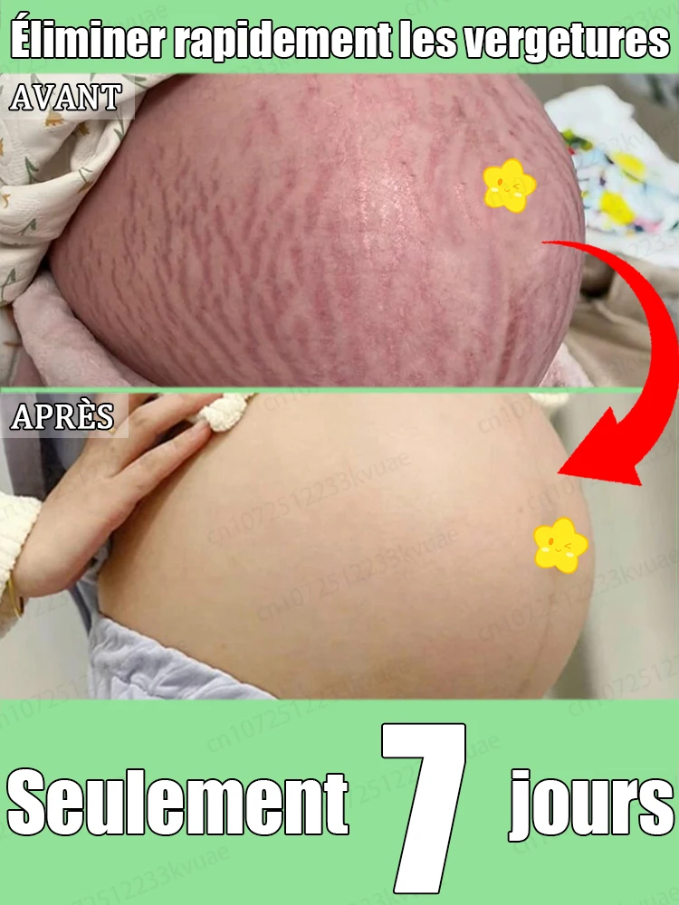 

Advanced Stretch Mark Removal Instrument for Post - Pregnancy Skin