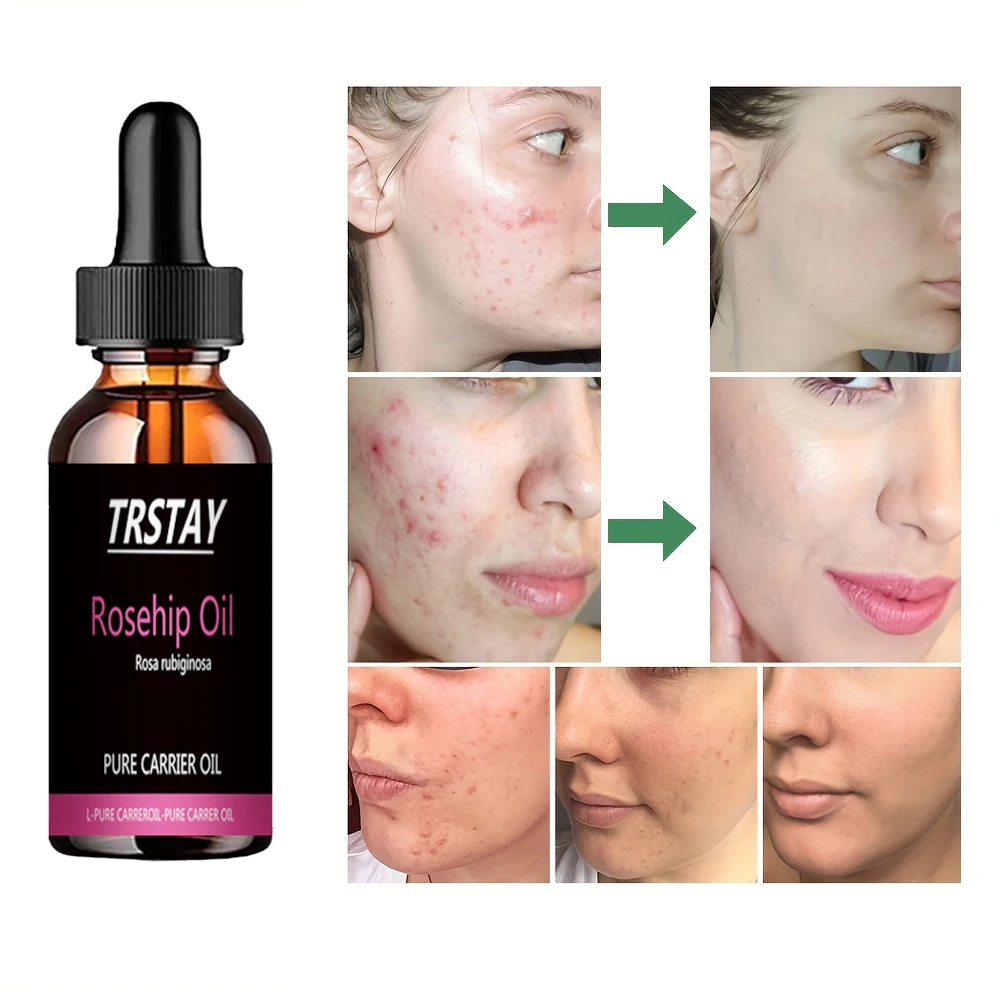 TRSTAY-aceite de semilla de Rosa Mosqueta orgánico, tratamiento antienvejecimiento 100% Natural para la piel de la cara