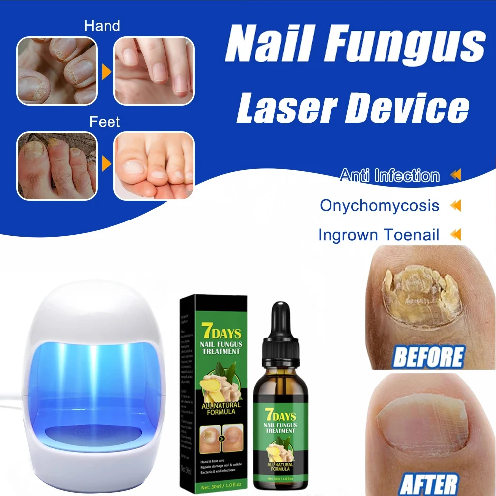 Nail Fungus Laser Treatment Device Fungal Treatment Feet Care Essence Anti Infection Paronychia Onychomycosis Ingrown Toenail