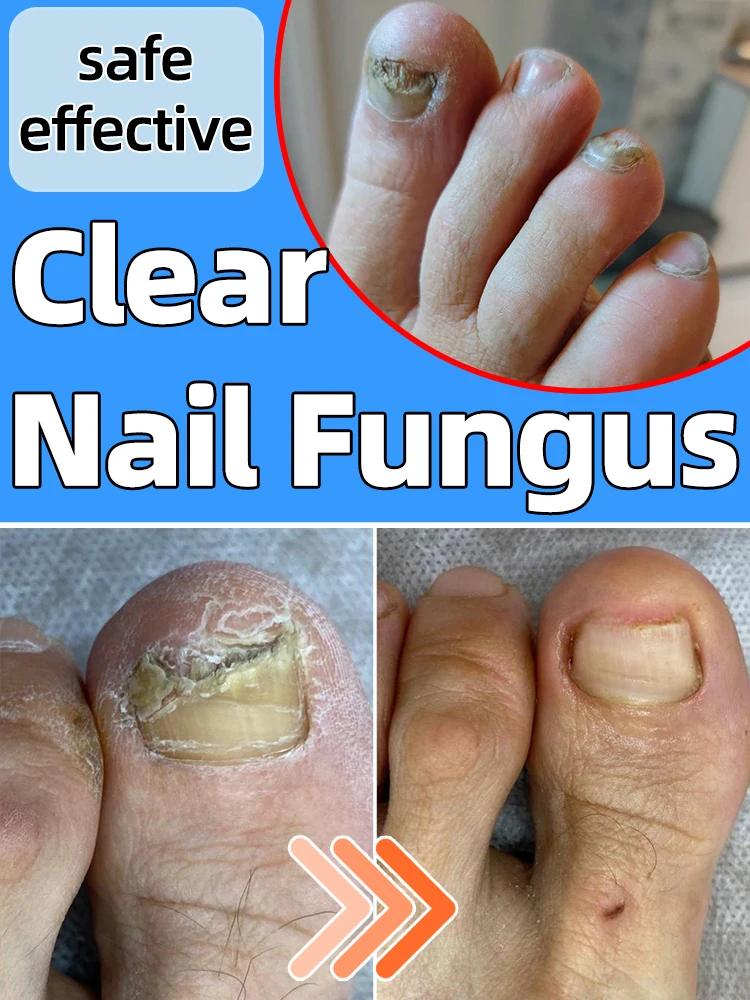 

clear all nail fungus