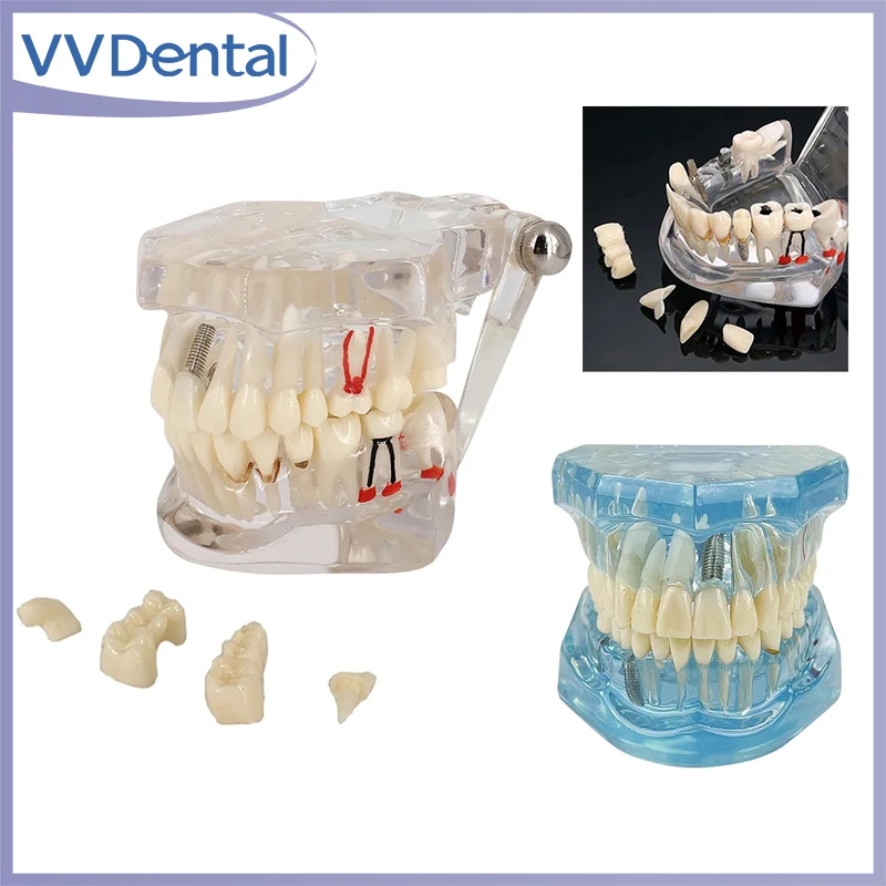 

Dental Disease Teeth Model With Restoration Bridge Tooth For Medical Science Dental Disease Teaching Study Model