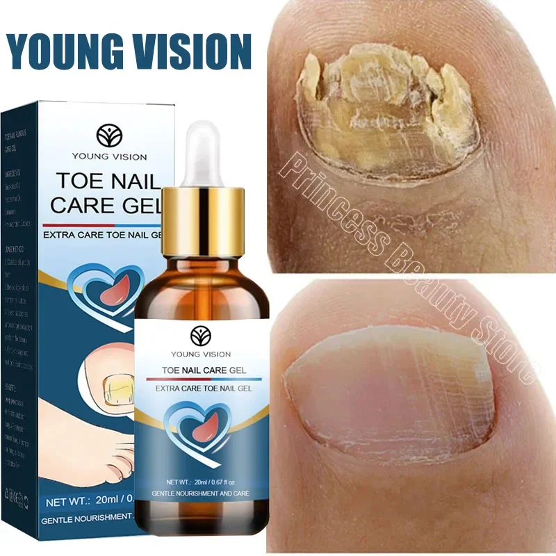 Nail Fungus Treatment Serum Foot Repair Liquid Toe Nails Fungal Removal Gel Anti Infection Paronychia Onychomycosis Cream 20ml