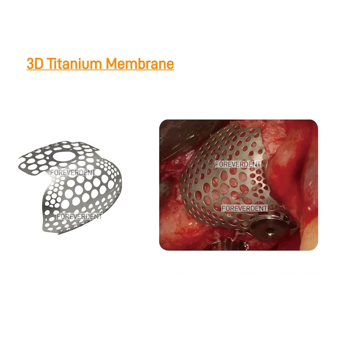 3D Smartbuilder GBR Bone Incremental Titanium Mesh Membrane Implant Dental Sidewall Bone Regeneration Nails Titanium Plates