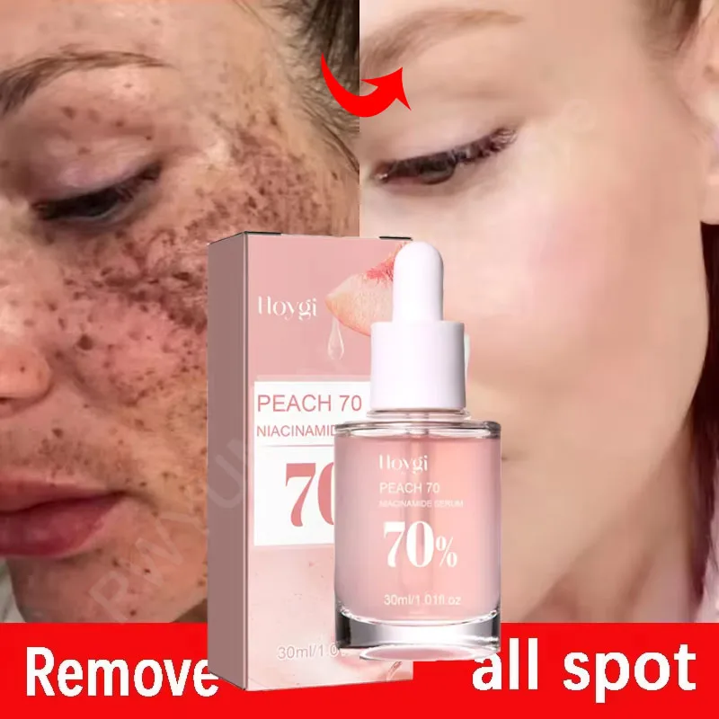 Niacinamide Dark Spots Remover Serum Face Freckle Melanin Correcting Essence Anti Pigmentation Whitening Brighten Dull Skin Care