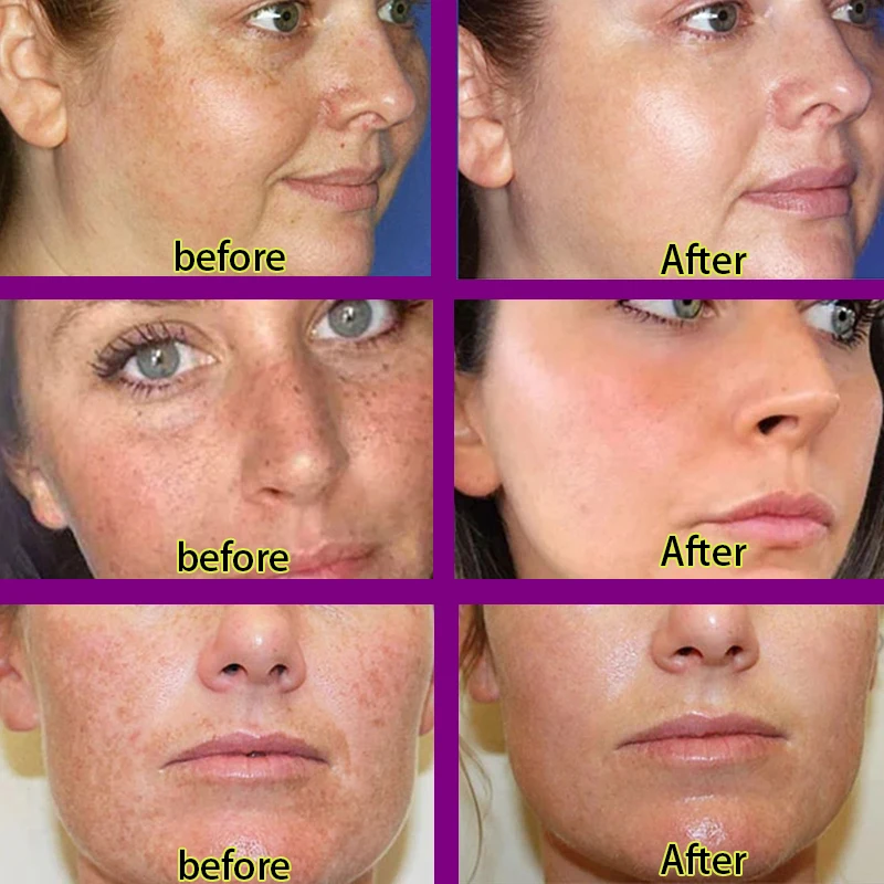 Dark Spot Remover For Face Freckles Melasma