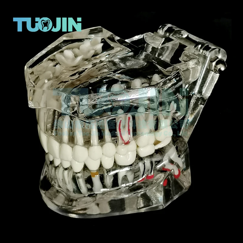1PCS Dental Disease Teaching Teeth Model Implant False Tooth Transparent Pathological Repair Training Study Demonstration Model