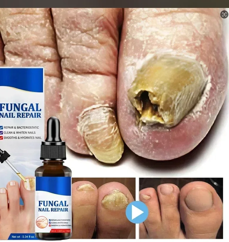 UñasFungal เล็บอุปกรณ์ซ่อม Fast เชื้อราเล็บ Onychomycosis ซ่อมเล็บเท้าเล็บมือลบเชื้อราเล็บเท้า Treatment