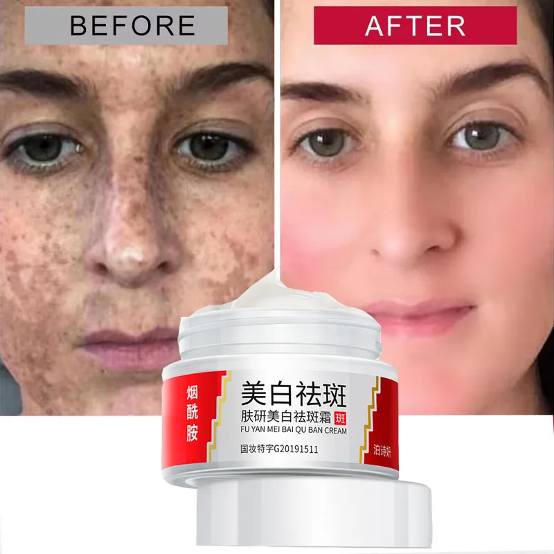 Freckle Whitening Cream Black Dots Melasma Remover Anti Brown Stain Lighten Pigmentation Moisturizing Skin Care Korean Products