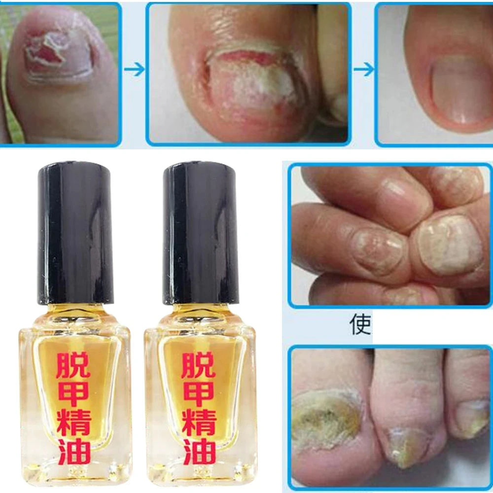 【buy 1 take 1】 Effect Fungus Removal Essence Liquid Fungal Nail Treatment Bright Nail Repair Anti Infection Foot Caring Plasters