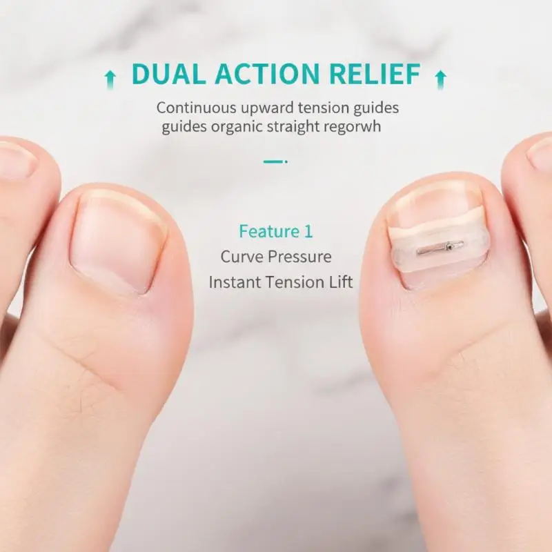 【Y】Portable Ingrown Toenail Corrector Tool Set 1 Set Pedicure Tools for Toe Nail Recovery Travel Use