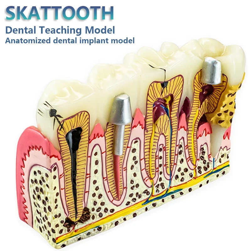 Dental Implante Model Restoration Pathological Tooth Model Dental Anatomical Model for Dental Teaching Training Dentist Learning