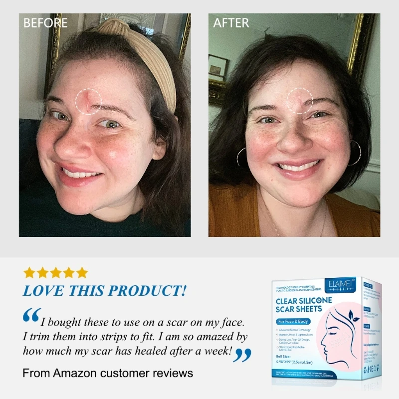 Phẫu thuật sinh mổ hiệu quả Gel Silicone Loại bỏ sẹo Tấm trị liệu Miếng dán trị mụn Chấn thương Đốt cháy Da phục hồi