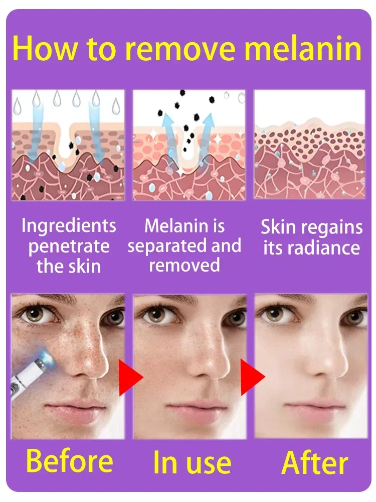 Age Dark Sun Spot Lentiggini Chloasma Trasparente