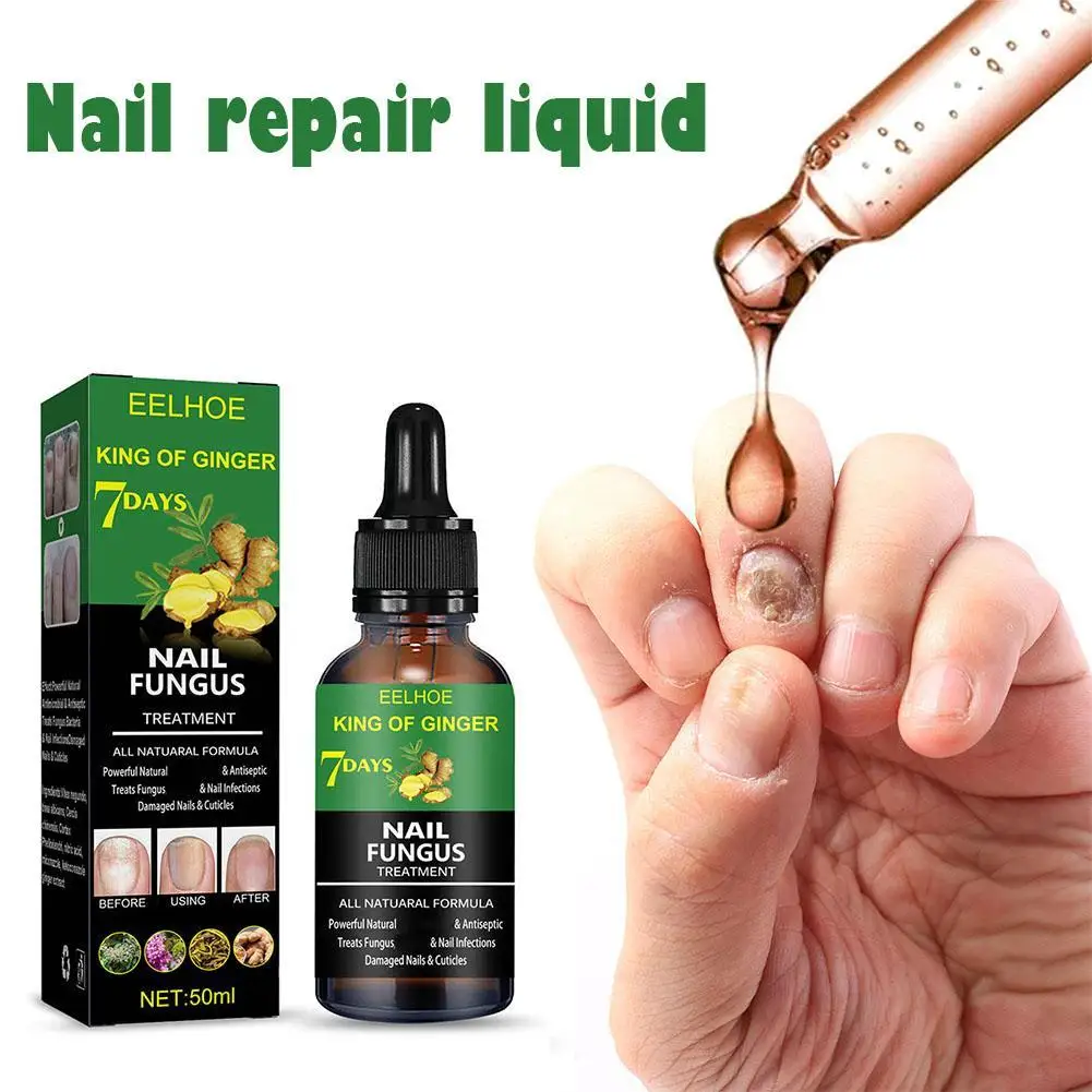 50ml Ginger Nail Fungal Treatments Feet Care Essencial Anti Infections Paronychia Onychomycosis Foot Toe Nail Care Repair Liquid