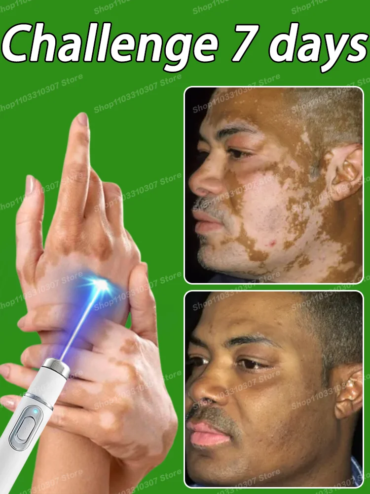 Crème de traitement Vitiligo, pommade de croissance de mélanine, élimine rapidement les taches blanches