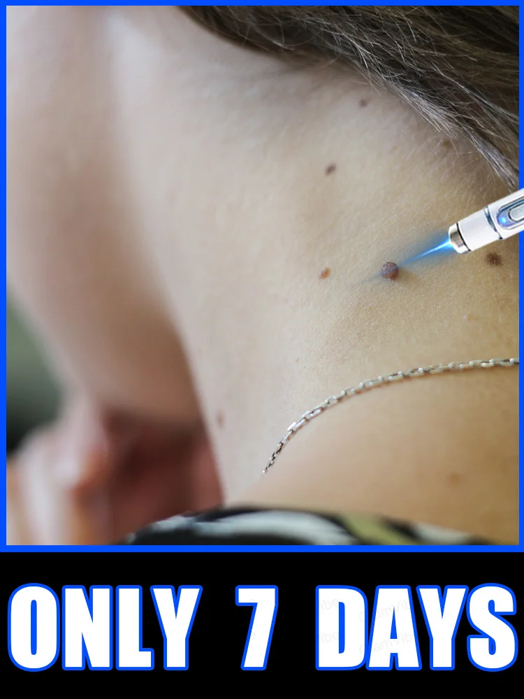 

2025 New Upgrade Blue Laser Solve Wart Tool