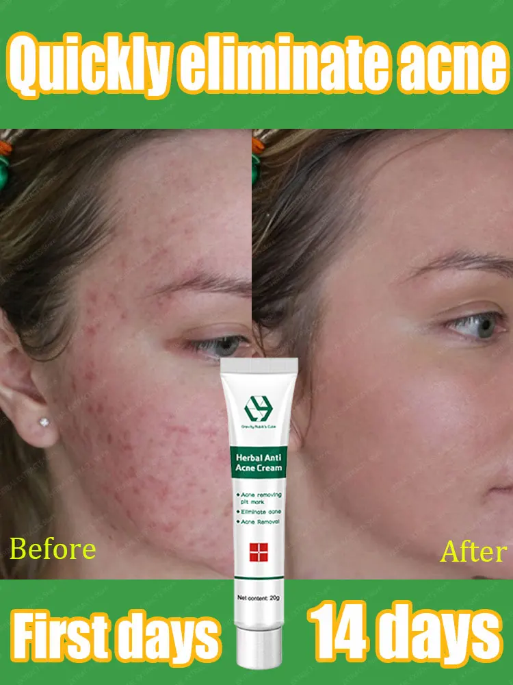 إصلاح بشرة الوجه وتعيد ندبات حب الشباب #1