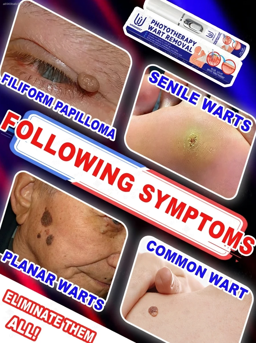 

ᵂᵃʳᵗ ʳᵉᵐᵒᵛᵃˡ ᵃᵗ ʰᵒᵐᵉ ⁱˢ ˢᵘᵖᵉʳ ᶜᵒⁿᵛᵉⁿⁱᵉⁿᵗ! Warts will gradually fall off 2026